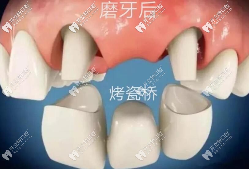 缺牙修復烤瓷橋 缺牙修復烤瓷橋