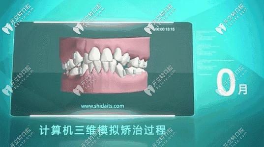 數(shù)字化隱形矯正的矯治過程 數(shù)字化隱形矯正的矯治過程