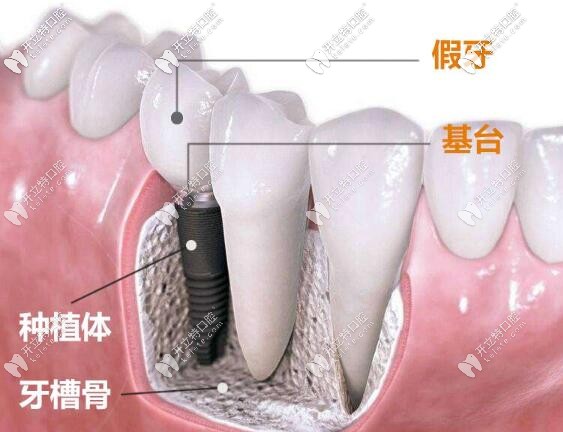 長(zhǎng)沙美奧種植牙價(jià)格表查詢:美奧口腔技術(shù)好價(jià)格也才3980一顆