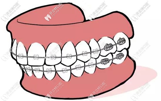 陶瓷自鎖托槽的價格及優(yōu)勢