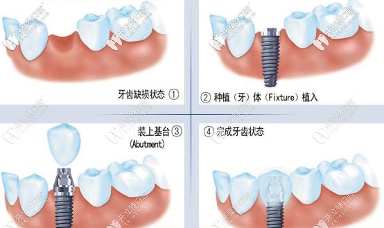 種植牙操作過程