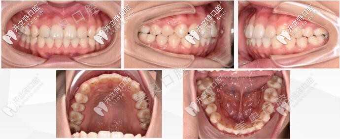 無(wú)錫美奧口腔牙齒矯正后的圖片