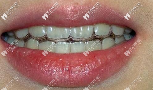 無(wú)錫美奧口腔顧客戴隱形牙套口內(nèi)照片