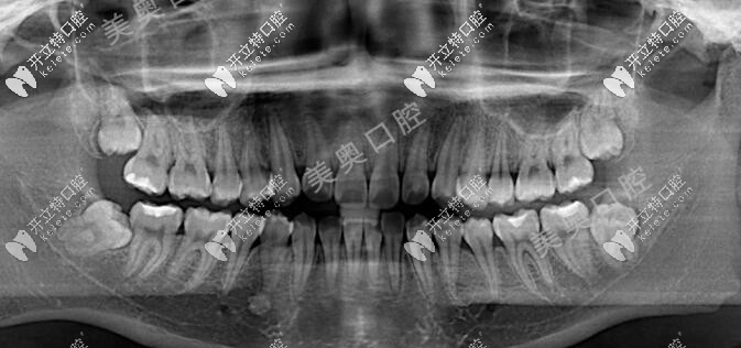 18歲牙齒矯正前X線(xiàn)片圖片