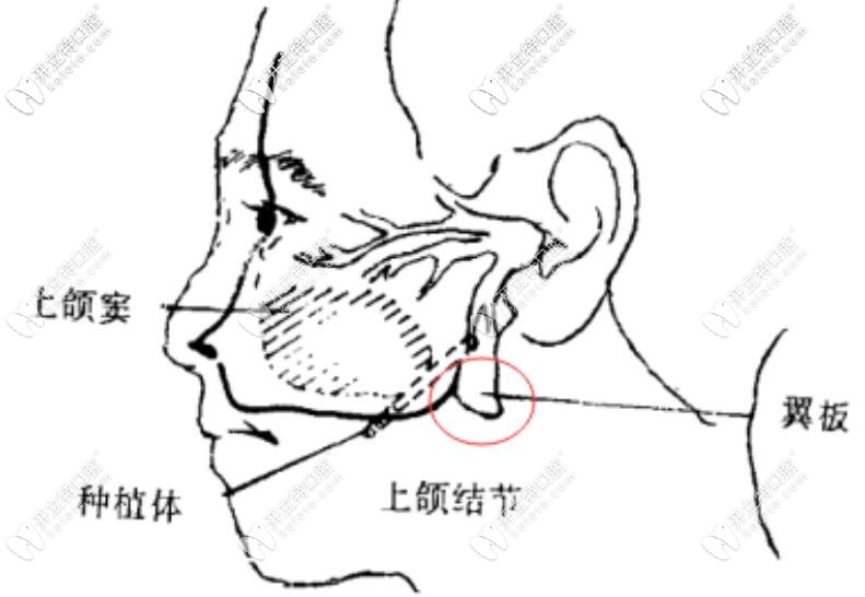穿翼板種植牙示意圖