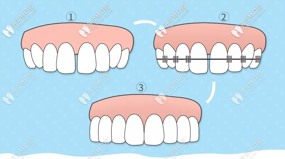 傳統(tǒng)的鋼絲矯正活動