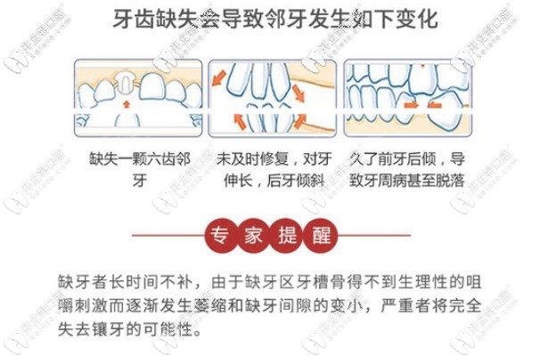 尹靜波主任提醒，長時間缺牙危害很大