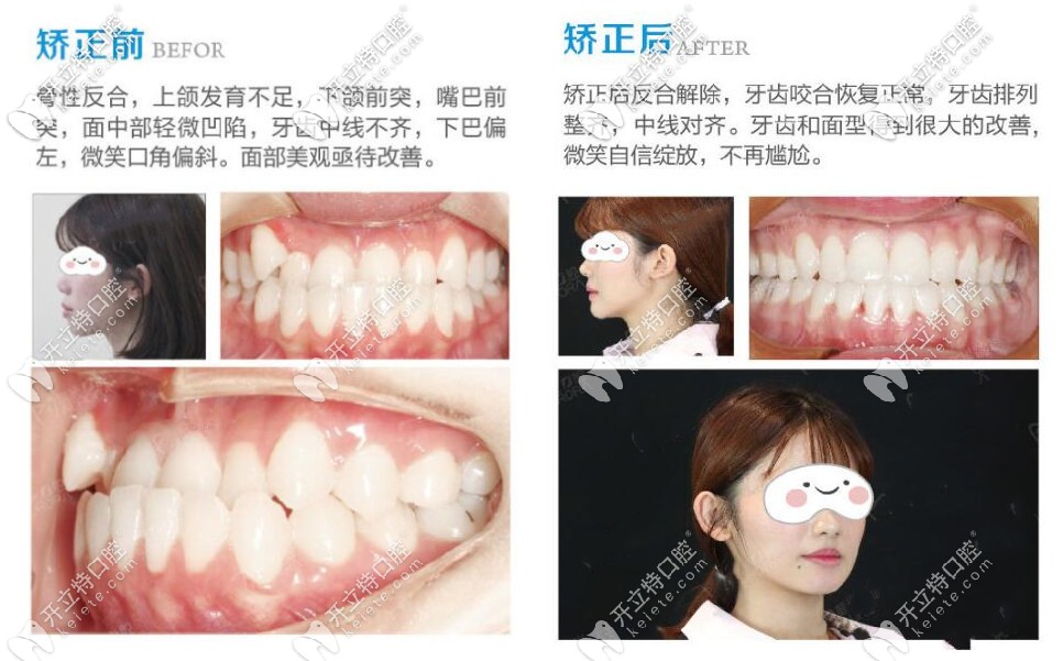 誰說26歲沒必要矯正牙齒了
