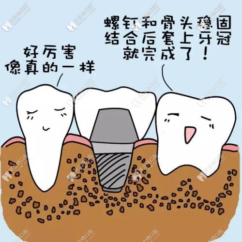 種植牙的過(guò)程