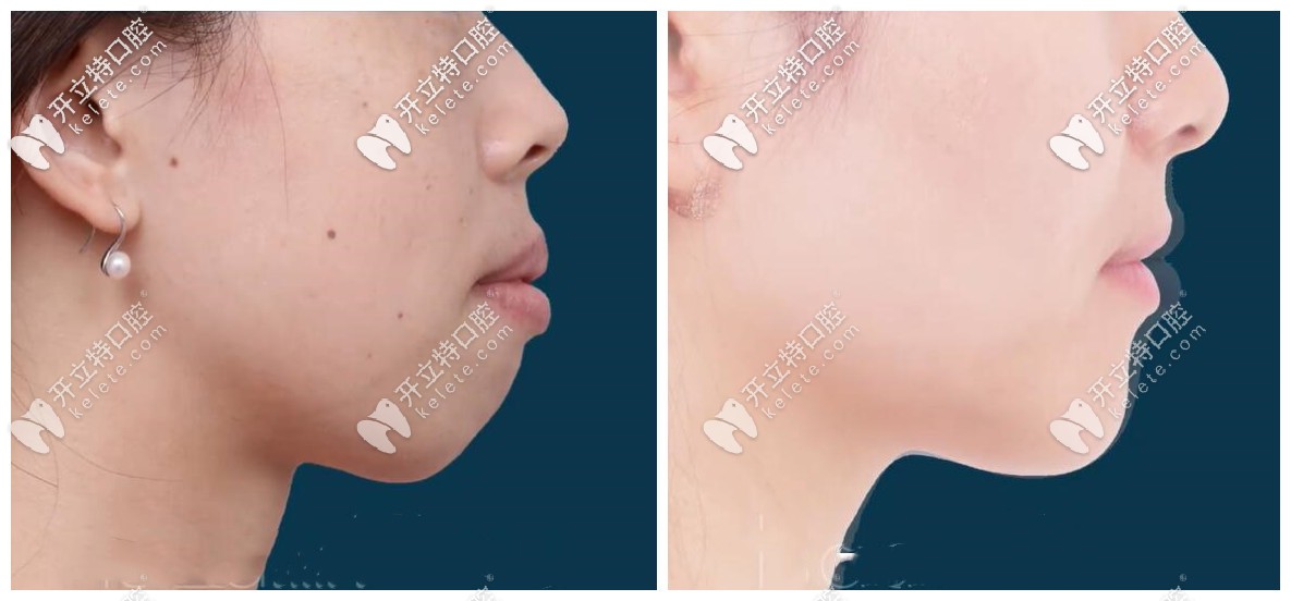 年齡28+的突嘴齙牙小姐姐表示，矯正不亞于整容