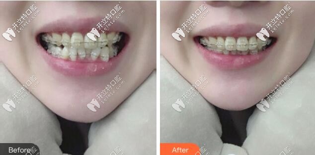 廣州壹加壹口腔陶瓷半隱形矯正