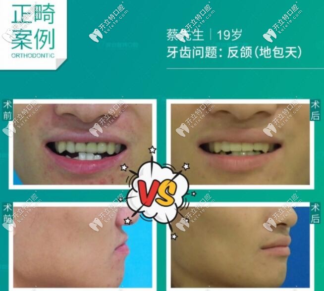 地包天牙齒矯正步驟復(fù)雜嗎?剛做完反頜矯正的小哥哥要發(fā)言