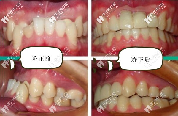 深圳登特口腔地包天牙齒矯正前后對比照片