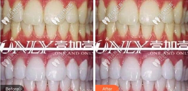 廣州壹加壹口腔冷光美白