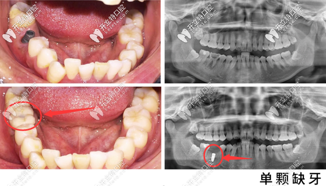 蘇州美奧口腔單顆種植牙案例
