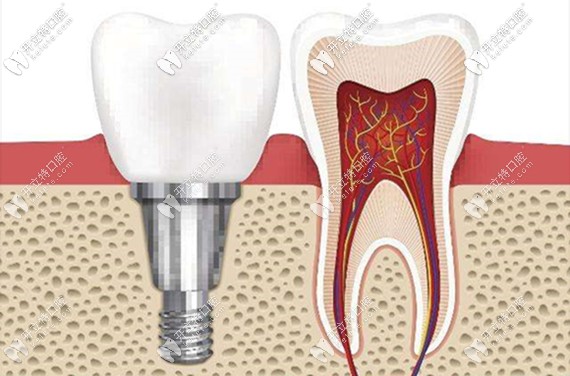 種植牙的費(fèi)用主要包含種植體、牙冠這兩大塊