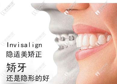 隱適美隱形牙套