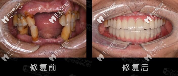 上頜牙槽骨萎縮,剛在深圳做穿顴穿翼板種植牙的真實(shí)經(jīng)歷