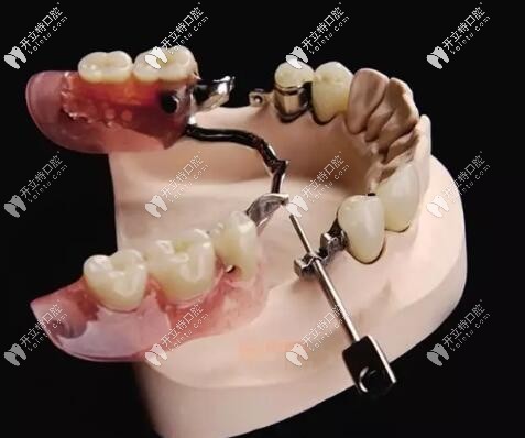 精密附著體義齒 精密附著體義齒