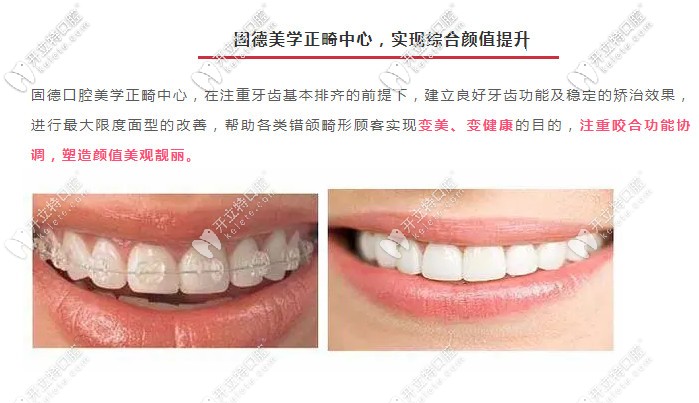 東莞牙齒矯正的費用