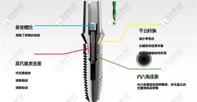 選擇種植牙，方方面面都要考慮到位