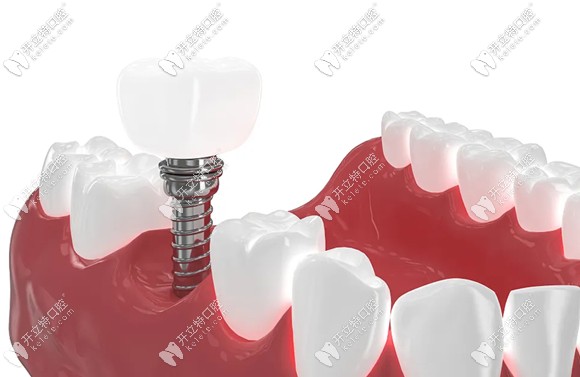 用數(shù)據(jù)解答:種植的牙齒與自己的真牙一樣耐用嗎?