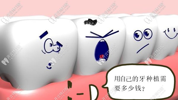 用自己的牙種植需要多少錢呢
