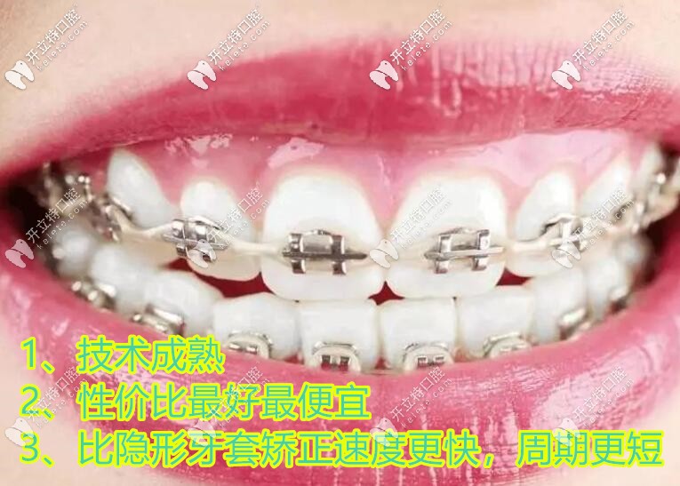 金屬鋼牙套優(yōu)勢