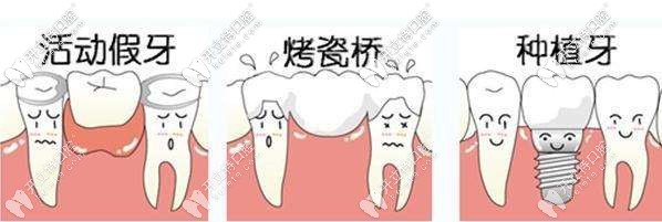 鑲牙分為活動(dòng)假牙、烤瓷牙及種植牙