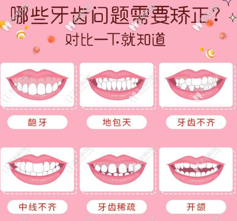 搞不清楚自己需不需要整牙，對比下就知道