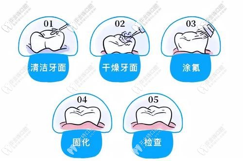 涂氟要經(jīng)過哪些步驟