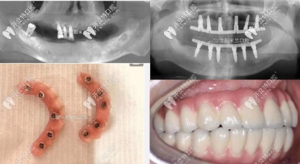 沈陽米蘭口腔全口種植牙案例