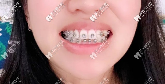 快該摘掉牙套啦，牙齒已經(jīng)排齊了