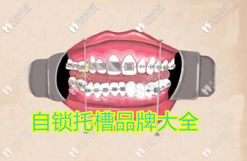 金屬自鎖牙套品牌大全匯總,說(shuō)說(shuō)國(guó)產(chǎn)和進(jìn)口到底有啥區(qū)別？