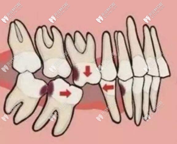 牙齒缺失不修復的危害 牙齒缺失不修復的危害