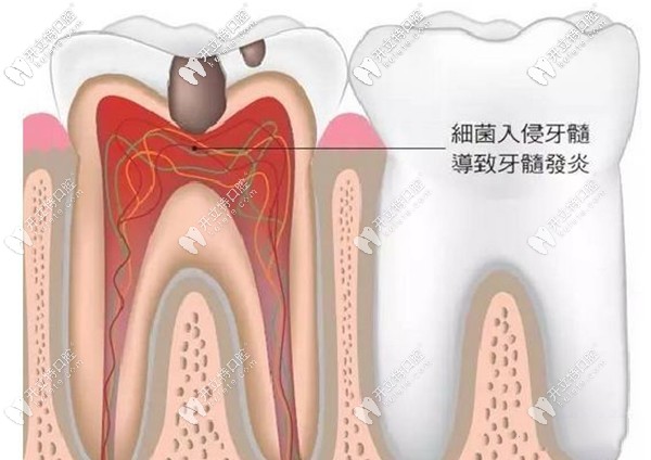 一次性根管治療的適應癥有哪些
