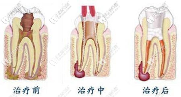 一次性根管治療的步驟流程