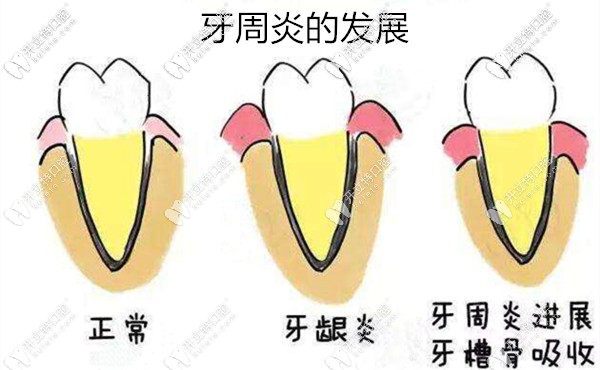 為什么年輕人得牙周炎