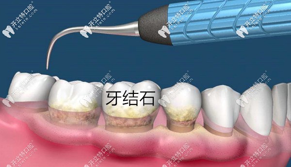 牙結石是牙周炎的致病因