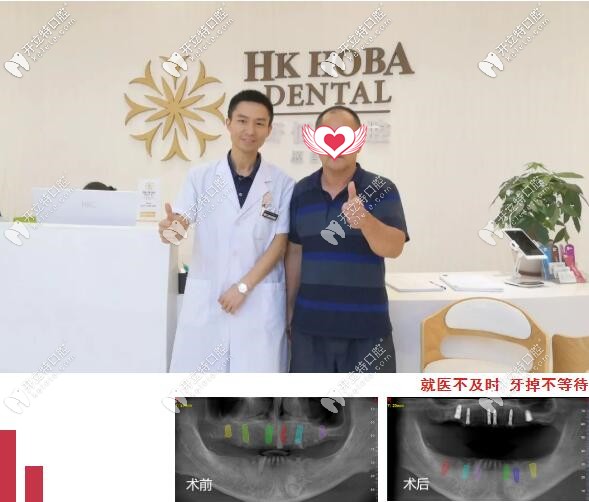 東莞好佰年全口種植牙案例