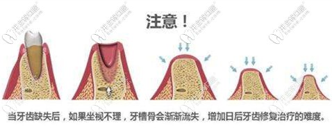 牙槽骨量不足帶來(lái)的危害