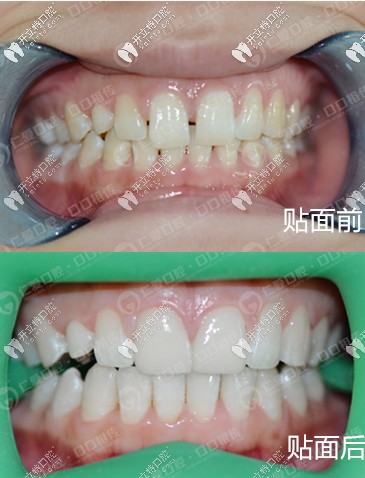 門牙稀疏美加超薄瓷貼面真人案例 <!--<i data=20240703-sp></i>-->口腔 門牙稀疏美加超薄瓷貼面真人案例 <!--<i data=20240703-sp></i>-->口腔