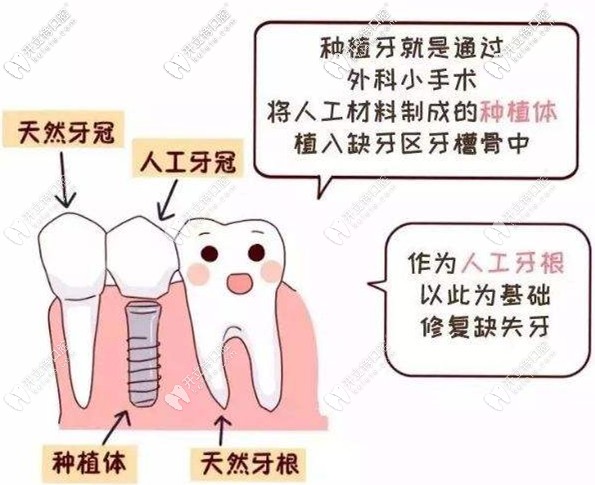 用圖解說(shuō)種植牙的特點(diǎn)
