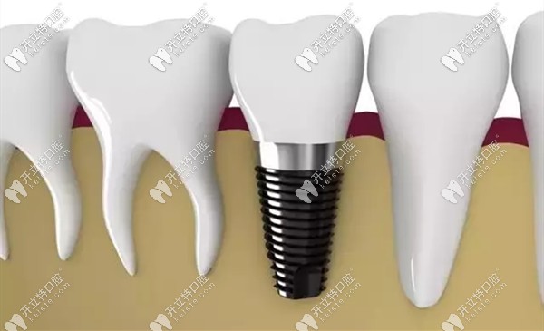 劉果生主任擅長各種復(fù)雜的口腔種植修復(fù)