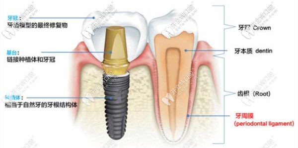 劉果生做一顆種植牙只用十多分鐘