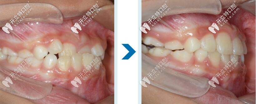 南寧柏樂(lè)口腔醫(yī)院隱形矯正