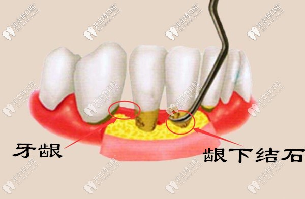 為什么牙結(jié)石會長到牙齦里面？齦下牙結(jié)石怎么處理？