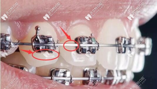 固定矯正器不利于清潔