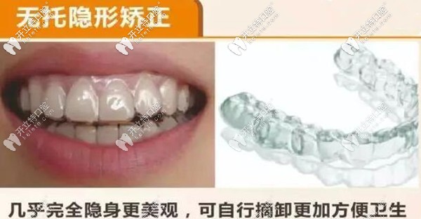 無托槽隱形矯正器