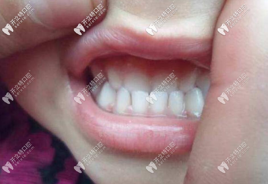 正畸較快多久能摘牙套？需要等到什么程度才可以取下